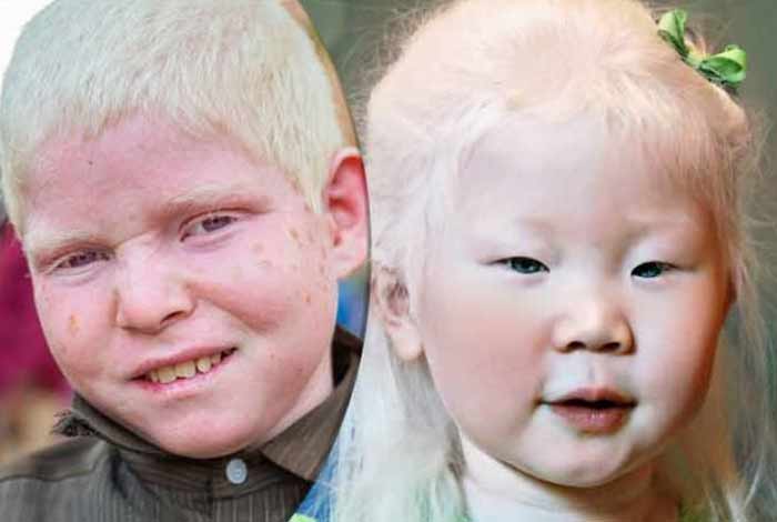 Albinism Archives - zovon