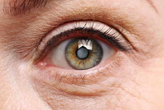 Cataracts Cataract