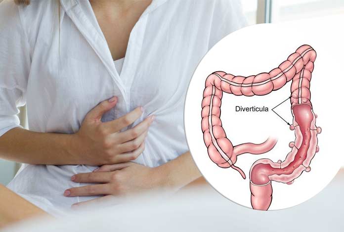 diverticulitis – causes, symptoms, diagnosis, prev