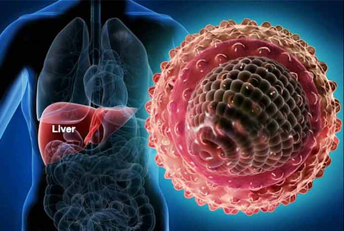 Hepatitis