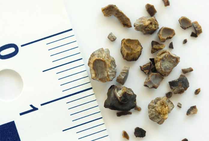 Kidney-Stone Kidney Stone