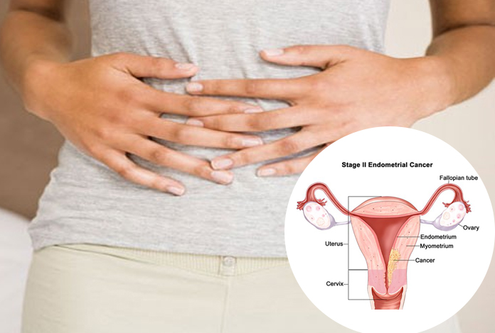 SEARCH AND BUY THIS PRODUCT Ovarian Cancer - Types, Symptoms, Causes, Diagnosis and