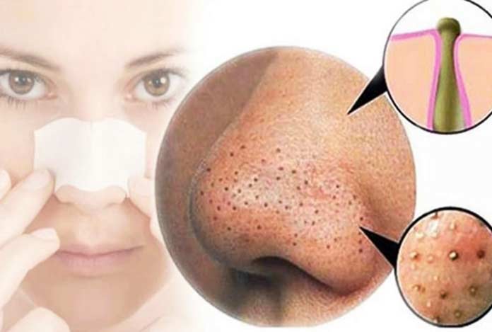 Simple Ways to Get Rid of Blackheads Simple Ways to Get Rid of Blackheads